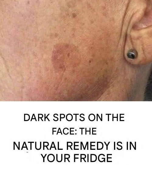 Dark spots on the face: The natural remedy is in your fridge