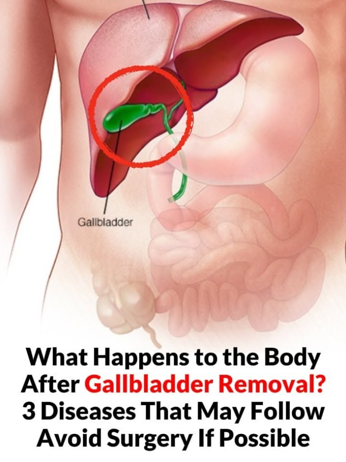 What Happens to the Body After Gallbladder Removal? 3 Diseases That May Follow Avoid Surgery If Possible